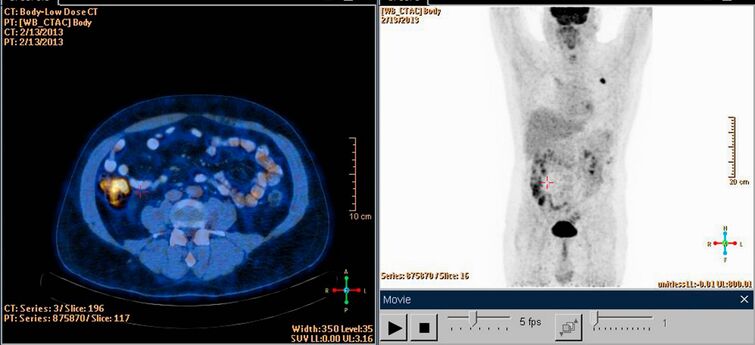 Nuclear Medicine – Virtual Information Session